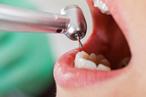 Best Chipped Tooth Repair Near Me  in Aloha, OR